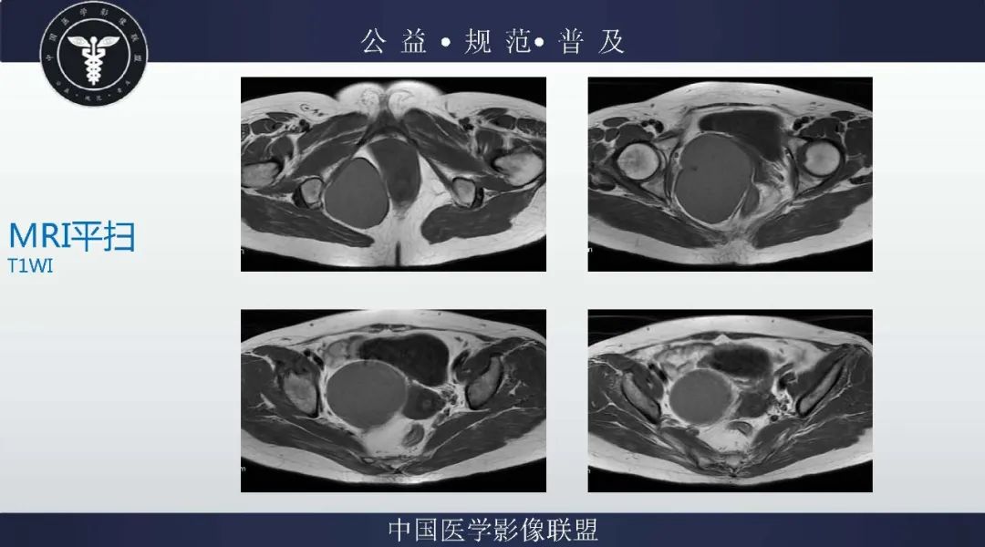 【病例】盆腔皮样囊肿1例MR影像