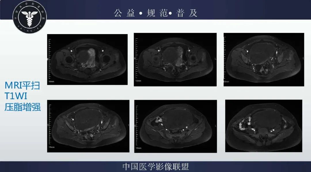 【病例】卵巢低级别浆液性囊腺癌1例CT及MR影像