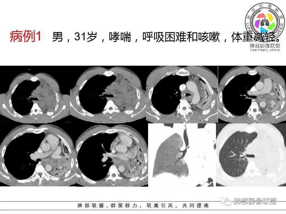 【PPT】侵袭性肺曲霉病影像分型及表现 【PPT】侵袭性肺曲霉病影像分型及表现