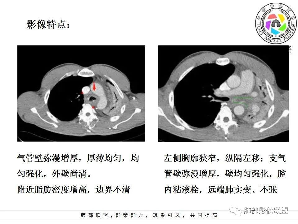 【PPT】侵袭性肺曲霉病影像分型及表现 【PPT】侵袭性肺曲霉病影像分型及表现