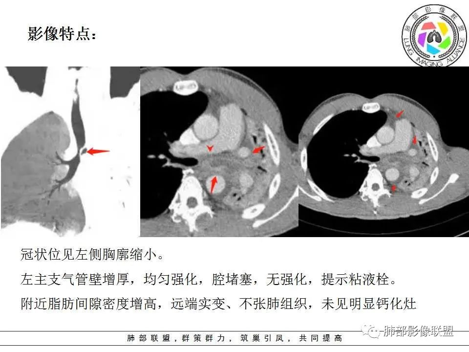 【PPT】侵袭性肺曲霉病影像分型及表现 【PPT】侵袭性肺曲霉病影像分型及表现