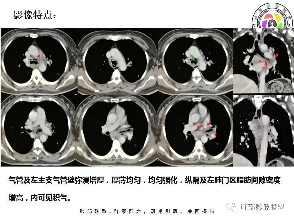【PPT】侵袭性肺曲霉病影像分型及表现 【PPT】侵袭性肺曲霉病影像分型及表现