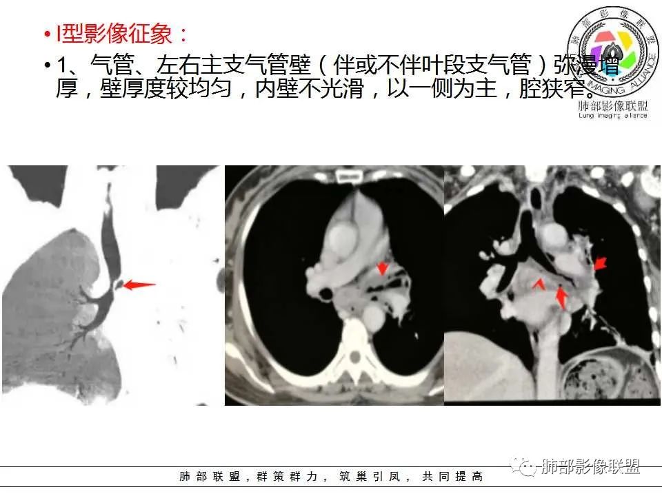 【PPT】侵袭性肺曲霉病影像分型及表现 【PPT】侵袭性肺曲霉病影像分型及表现