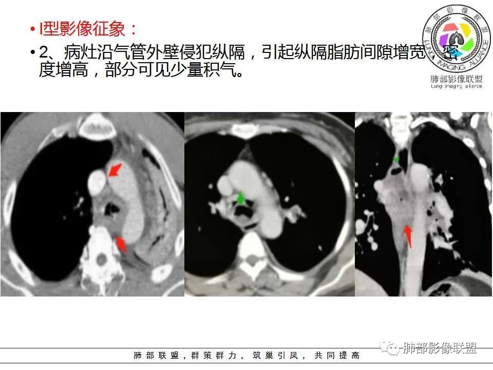 【PPT】侵袭性肺曲霉病影像分型及表现 【PPT】侵袭性肺曲霉病影像分型及表现