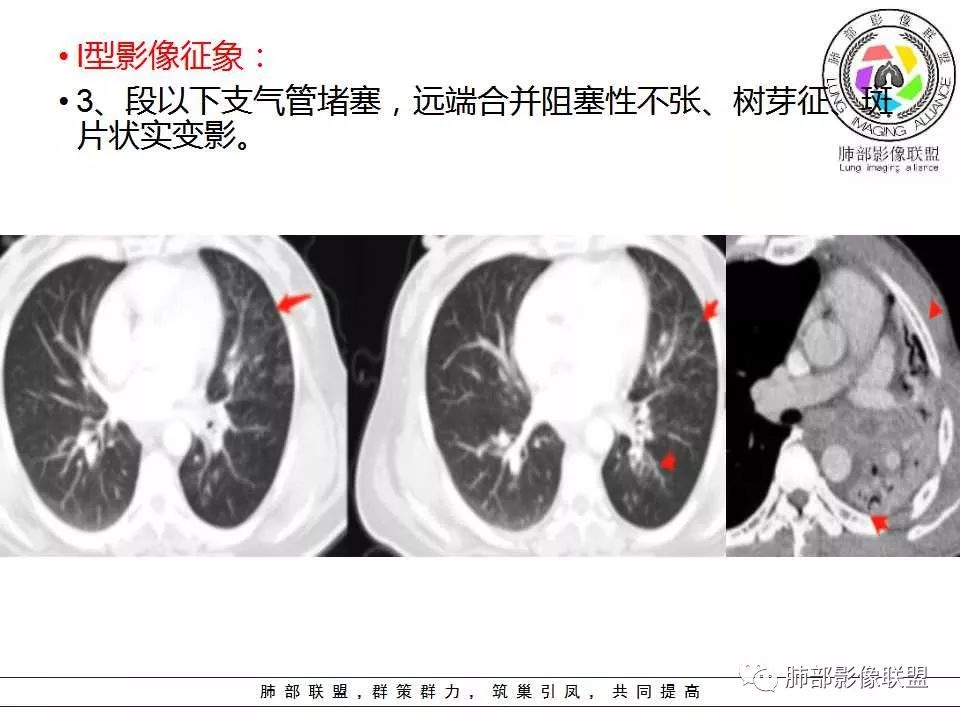 【PPT】侵袭性肺曲霉病影像分型及表现 【PPT】侵袭性肺曲霉病影像分型及表现
