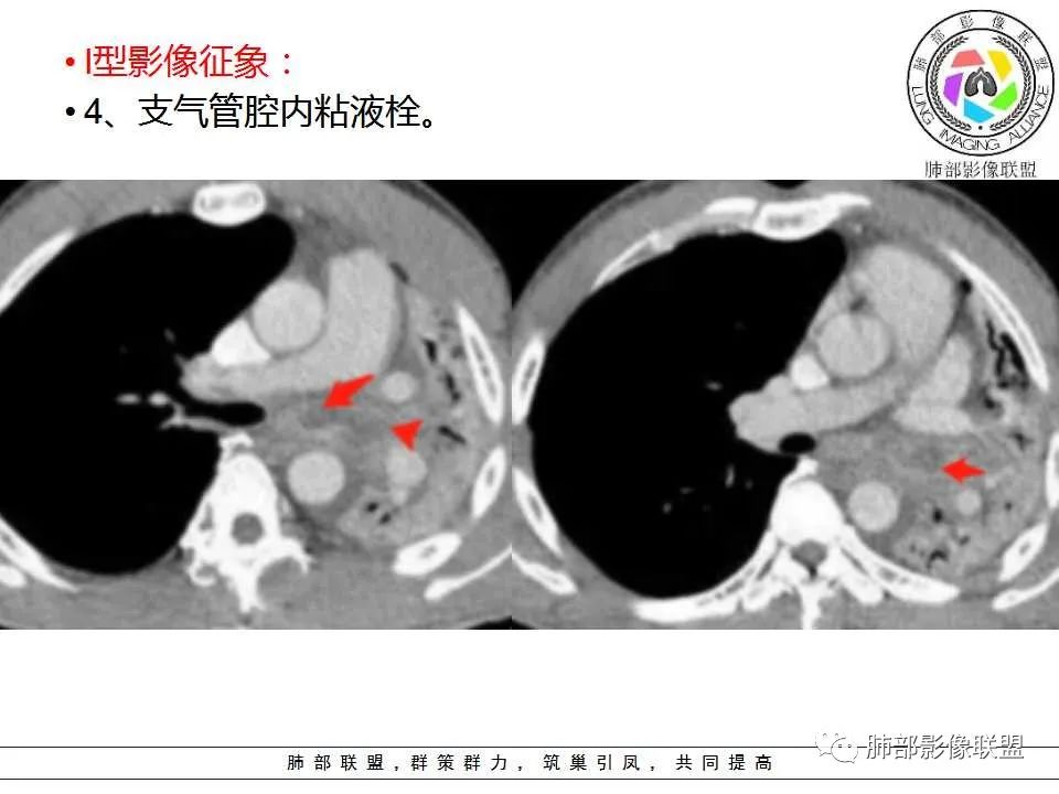 【PPT】侵袭性肺曲霉病影像分型及表现 【PPT】侵袭性肺曲霉病影像分型及表现