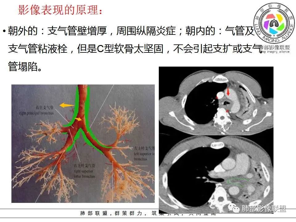 【PPT】侵袭性肺曲霉病影像分型及表现 【PPT】侵袭性肺曲霉病影像分型及表现