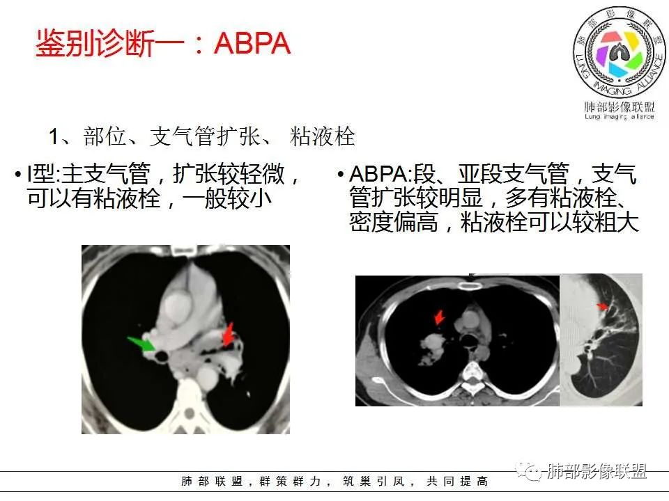 【PPT】侵袭性肺曲霉病影像分型及表现 【PPT】侵袭性肺曲霉病影像分型及表现