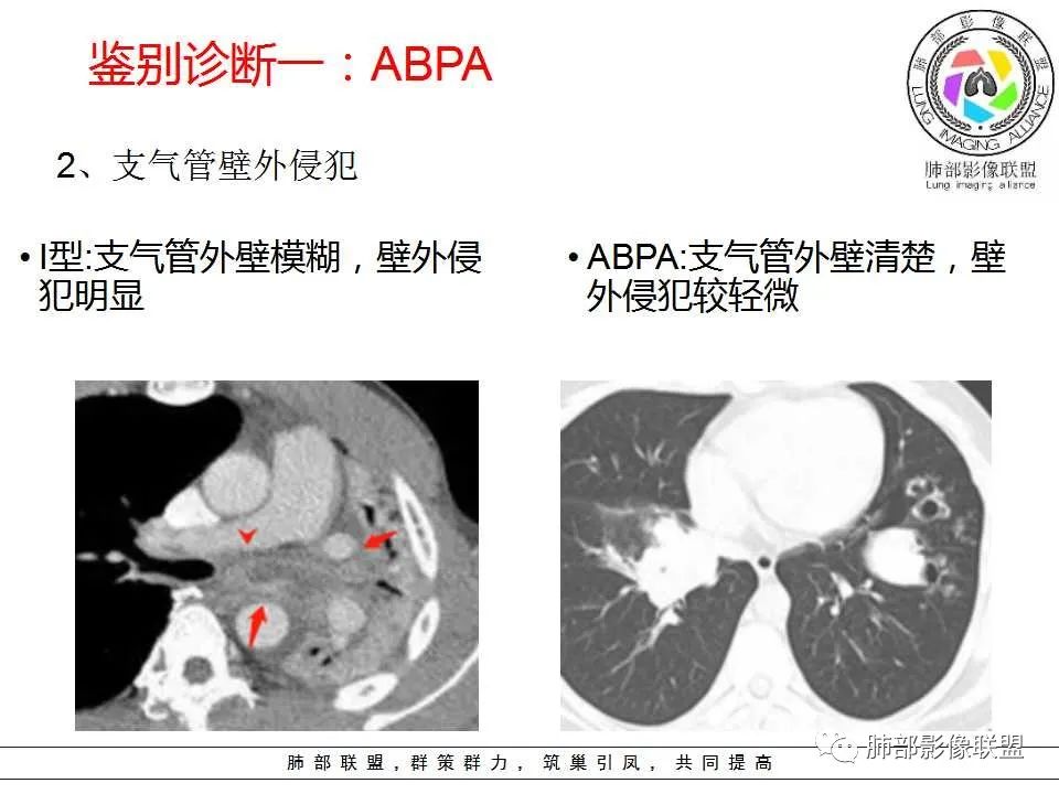 【PPT】侵袭性肺曲霉病影像分型及表现 【PPT】侵袭性肺曲霉病影像分型及表现