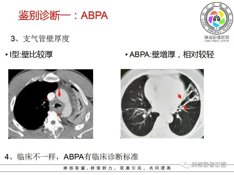 【PPT】侵袭性肺曲霉病影像分型及表现 【PPT】侵袭性肺曲霉病影像分型及表现