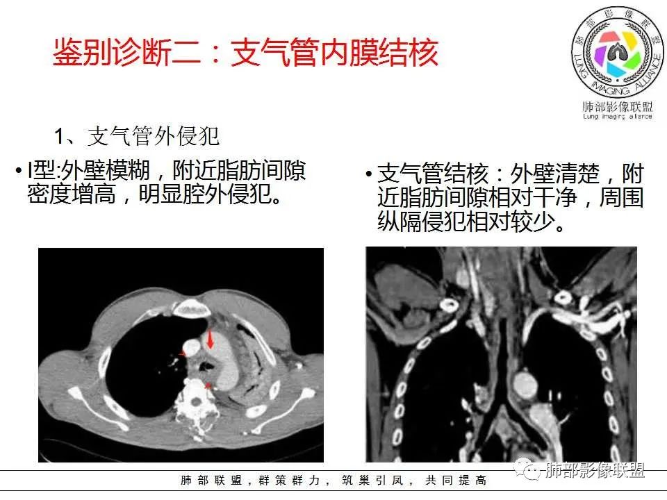 【PPT】侵袭性肺曲霉病影像分型及表现 【PPT】侵袭性肺曲霉病影像分型及表现