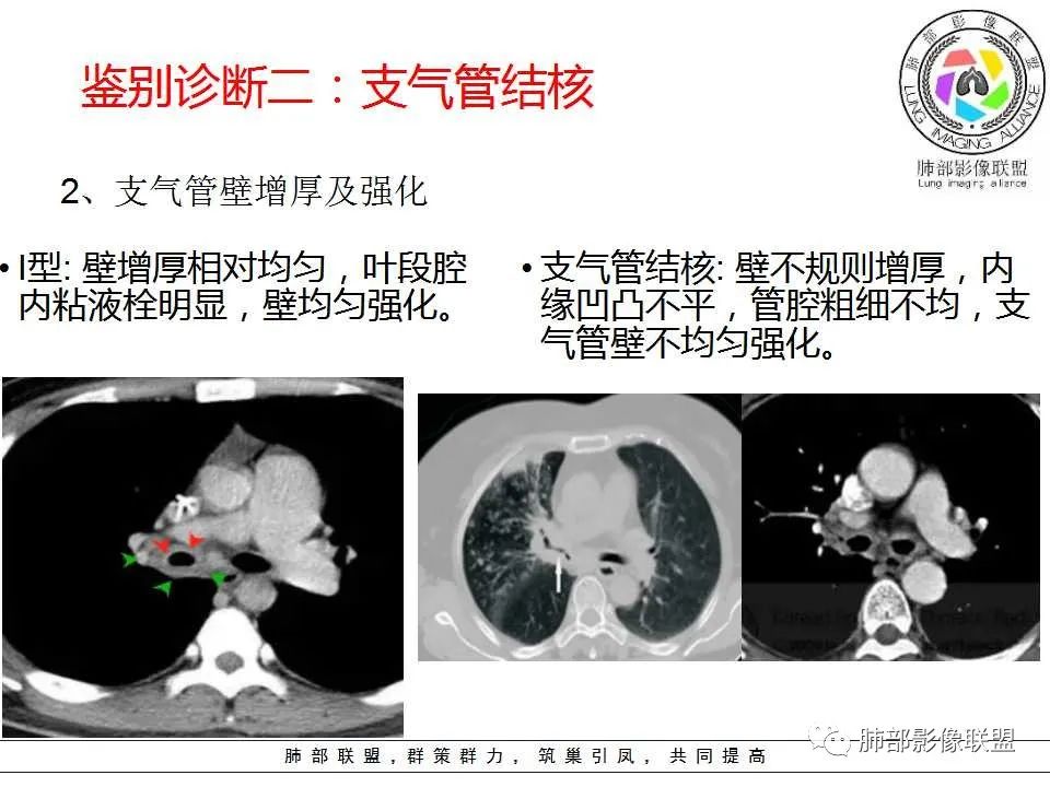 【PPT】侵袭性肺曲霉病影像分型及表现 【PPT】侵袭性肺曲霉病影像分型及表现