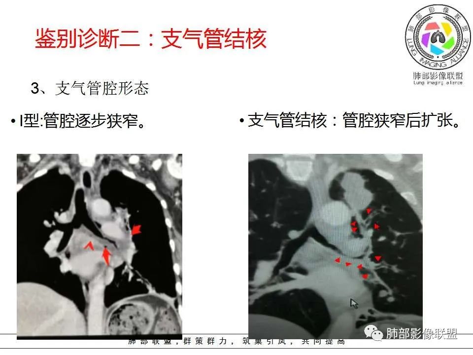 【PPT】侵袭性肺曲霉病影像分型及表现 【PPT】侵袭性肺曲霉病影像分型及表现