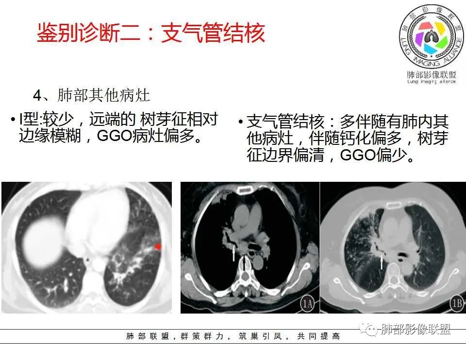 【PPT】侵袭性肺曲霉病影像分型及表现 【PPT】侵袭性肺曲霉病影像分型及表现