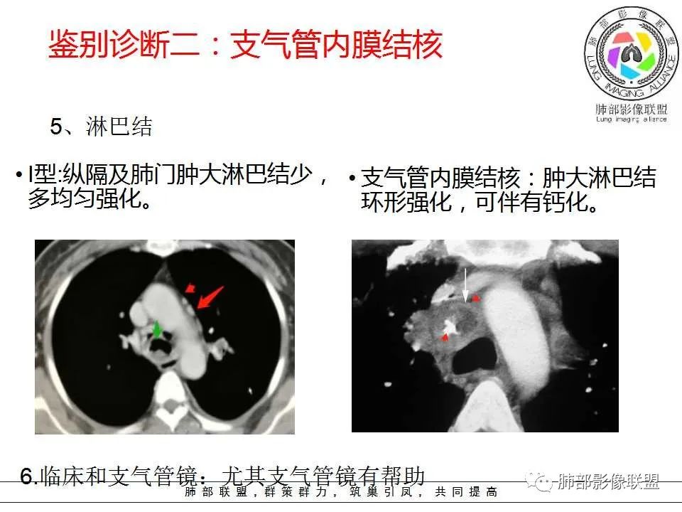 【PPT】侵袭性肺曲霉病影像分型及表现 【PPT】侵袭性肺曲霉病影像分型及表现