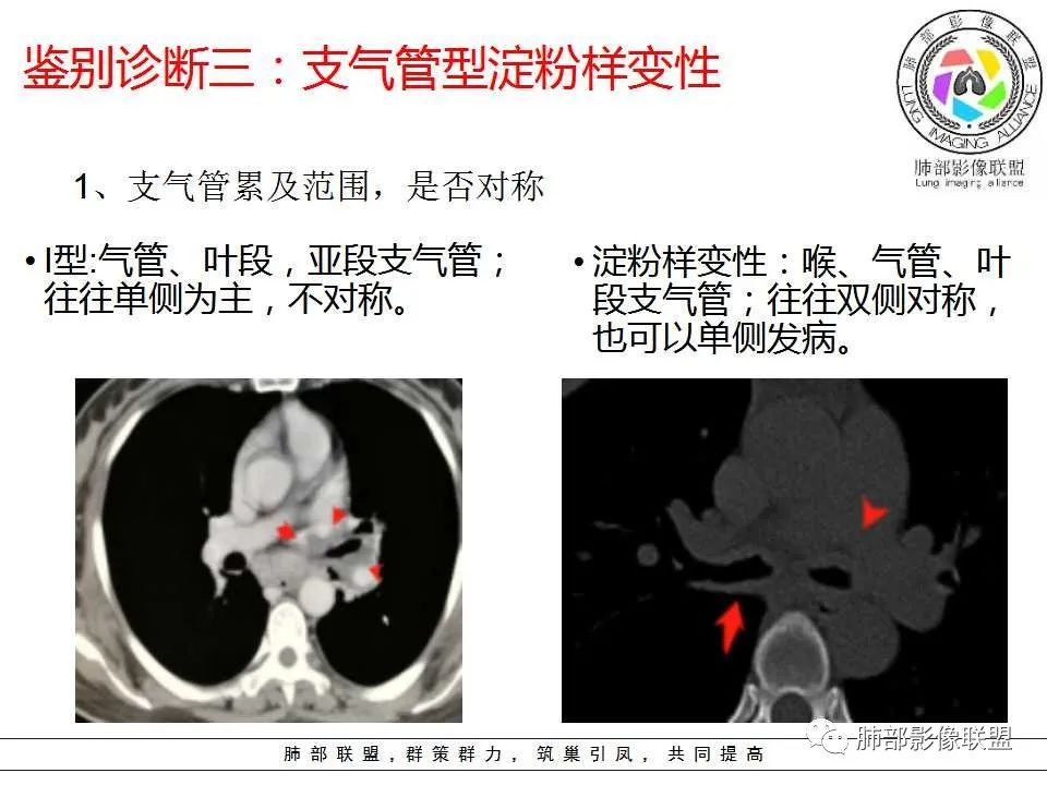 【PPT】侵袭性肺曲霉病影像分型及表现 【PPT】侵袭性肺曲霉病影像分型及表现