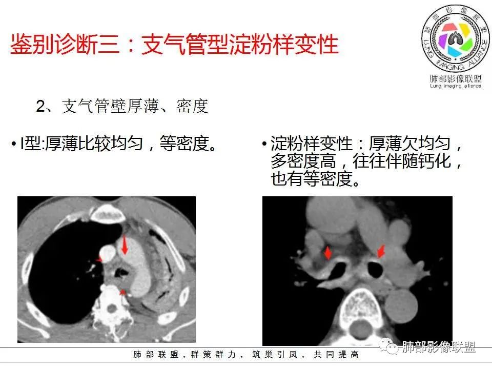【PPT】侵袭性肺曲霉病影像分型及表现 【PPT】侵袭性肺曲霉病影像分型及表现