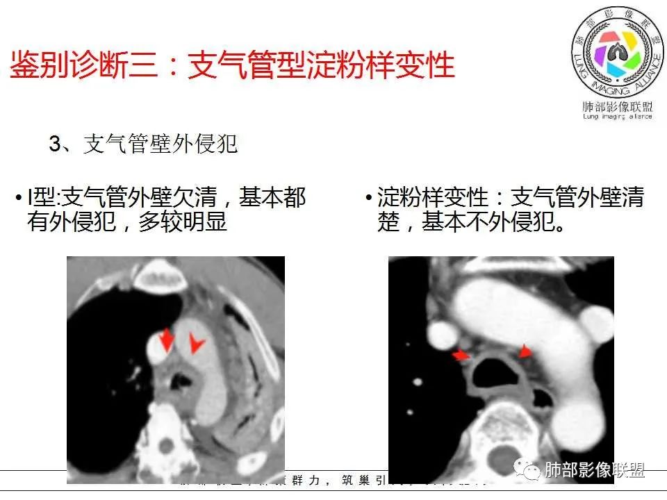 【PPT】侵袭性肺曲霉病影像分型及表现 【PPT】侵袭性肺曲霉病影像分型及表现