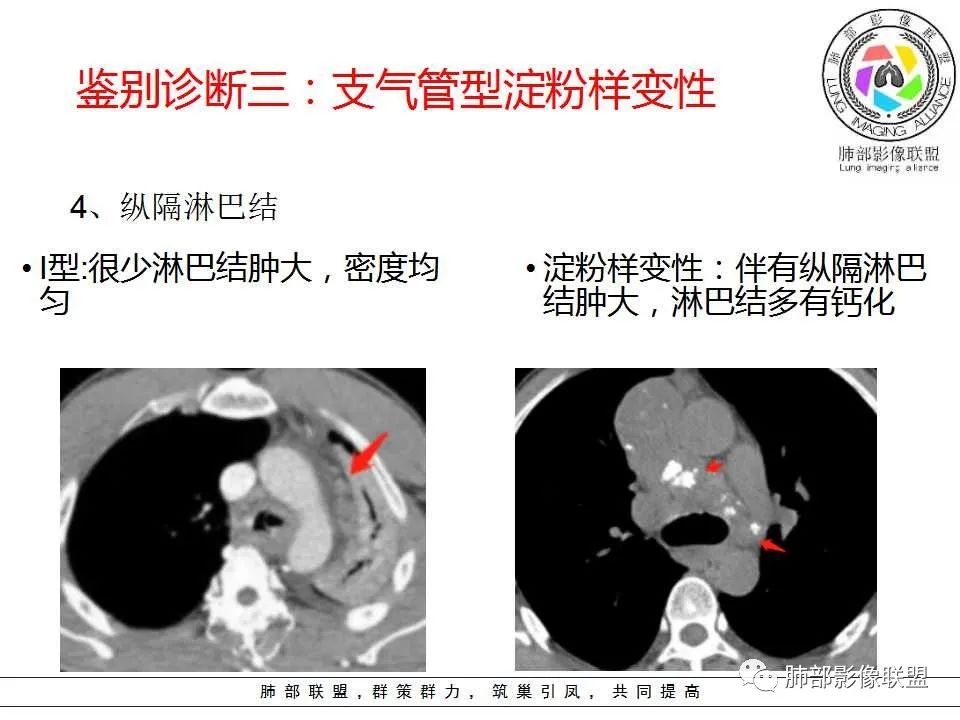 【PPT】侵袭性肺曲霉病影像分型及表现 【PPT】侵袭性肺曲霉病影像分型及表现
