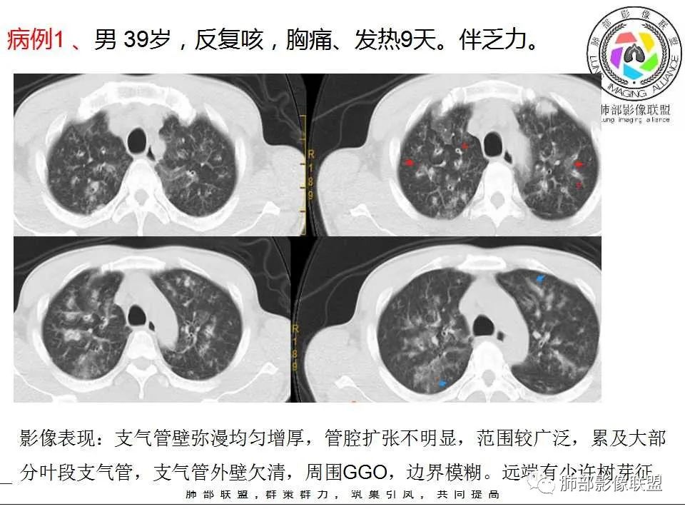 【PPT】侵袭性肺曲霉病影像分型及表现 【PPT】侵袭性肺曲霉病影像分型及表现