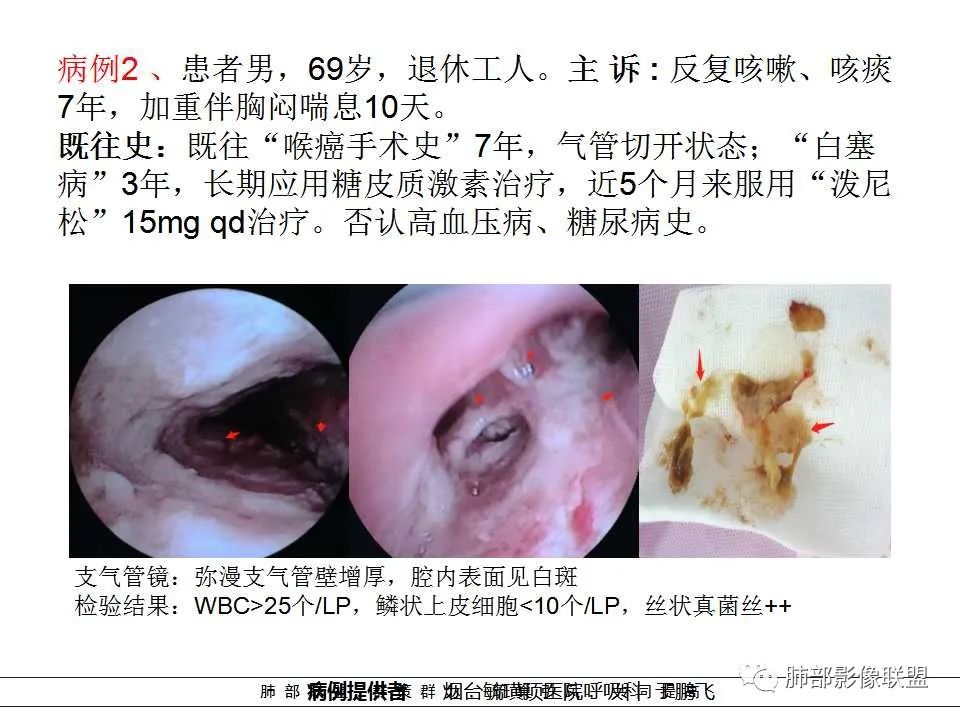 【PPT】侵袭性肺曲霉病影像分型及表现 【PPT】侵袭性肺曲霉病影像分型及表现