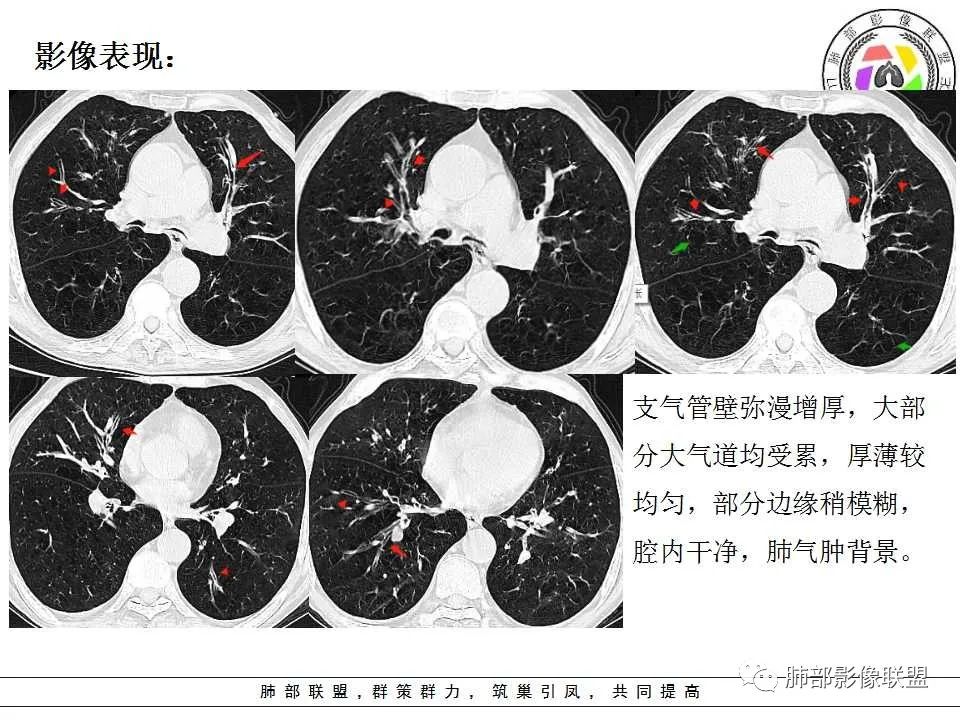 【PPT】侵袭性肺曲霉病影像分型及表现 【PPT】侵袭性肺曲霉病影像分型及表现