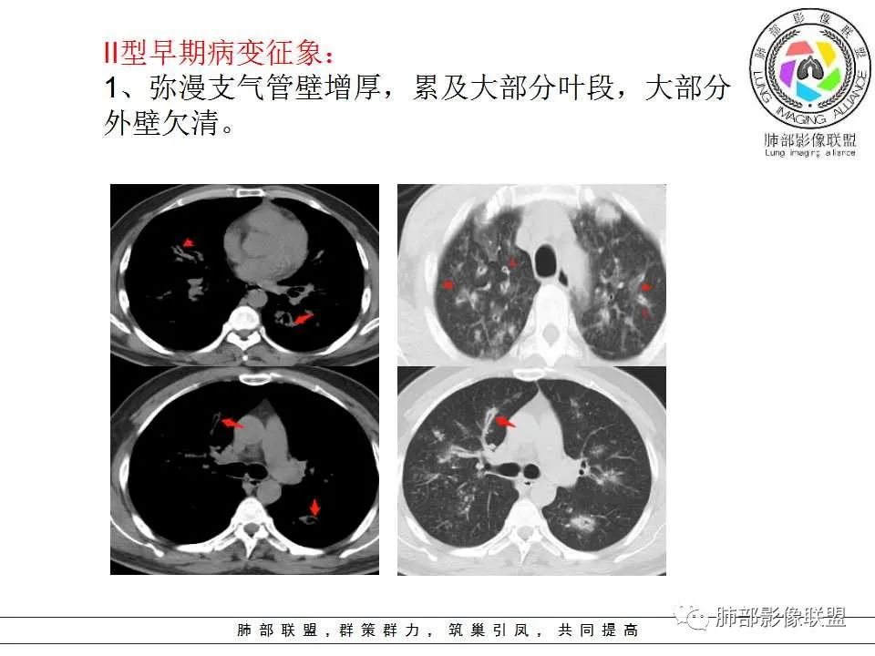 【PPT】侵袭性肺曲霉病影像分型及表现 【PPT】侵袭性肺曲霉病影像分型及表现