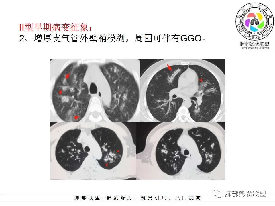 【PPT】侵袭性肺曲霉病影像分型及表现 【PPT】侵袭性肺曲霉病影像分型及表现
