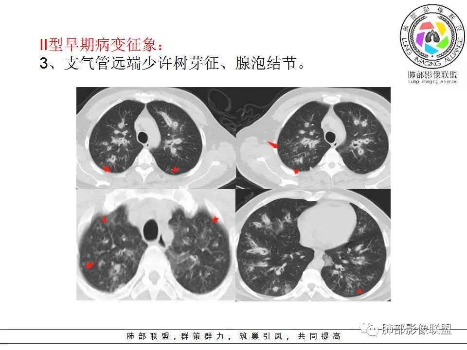 【PPT】侵袭性肺曲霉病影像分型及表现 【PPT】侵袭性肺曲霉病影像分型及表现