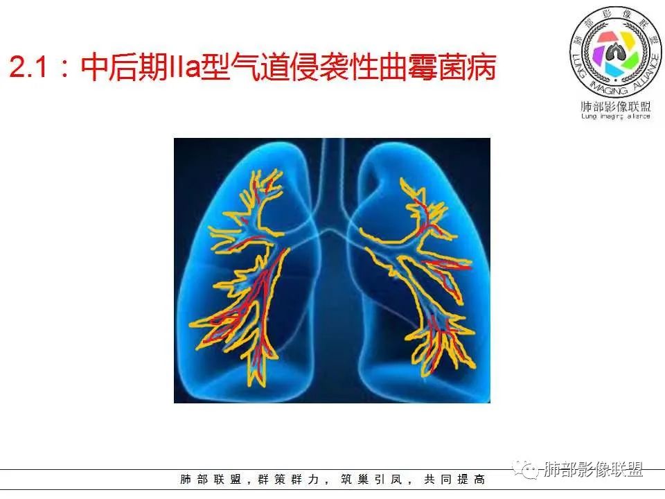 【PPT】侵袭性肺曲霉病影像分型及表现 【PPT】侵袭性肺曲霉病影像分型及表现