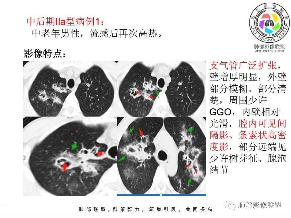【PPT】侵袭性肺曲霉病影像分型及表现 【PPT】侵袭性肺曲霉病影像分型及表现