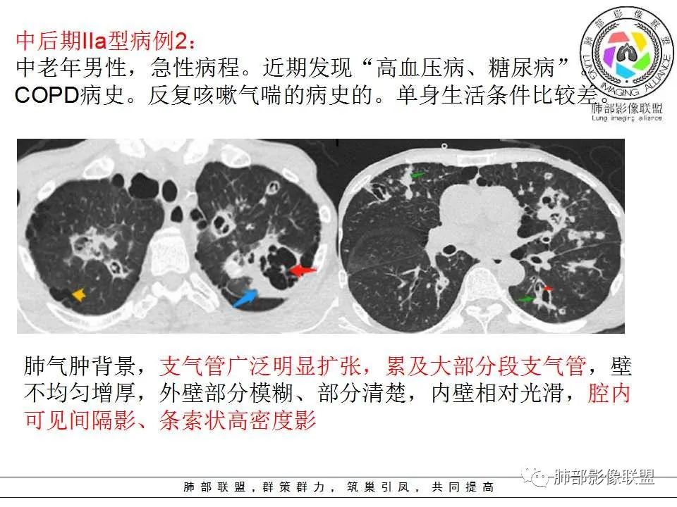 【PPT】侵袭性肺曲霉病影像分型及表现 【PPT】侵袭性肺曲霉病影像分型及表现