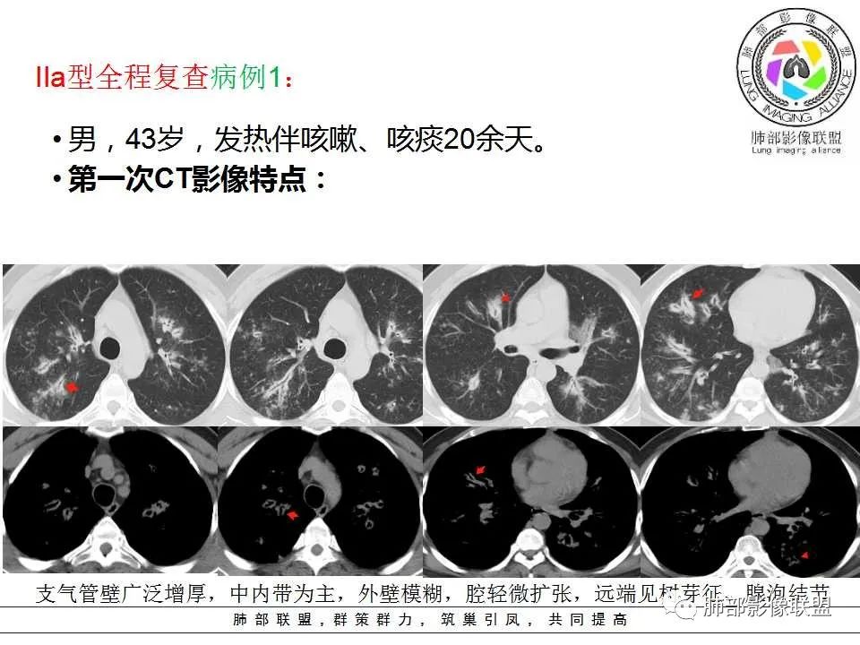 【PPT】侵袭性肺曲霉病影像分型及表现 【PPT】侵袭性肺曲霉病影像分型及表现