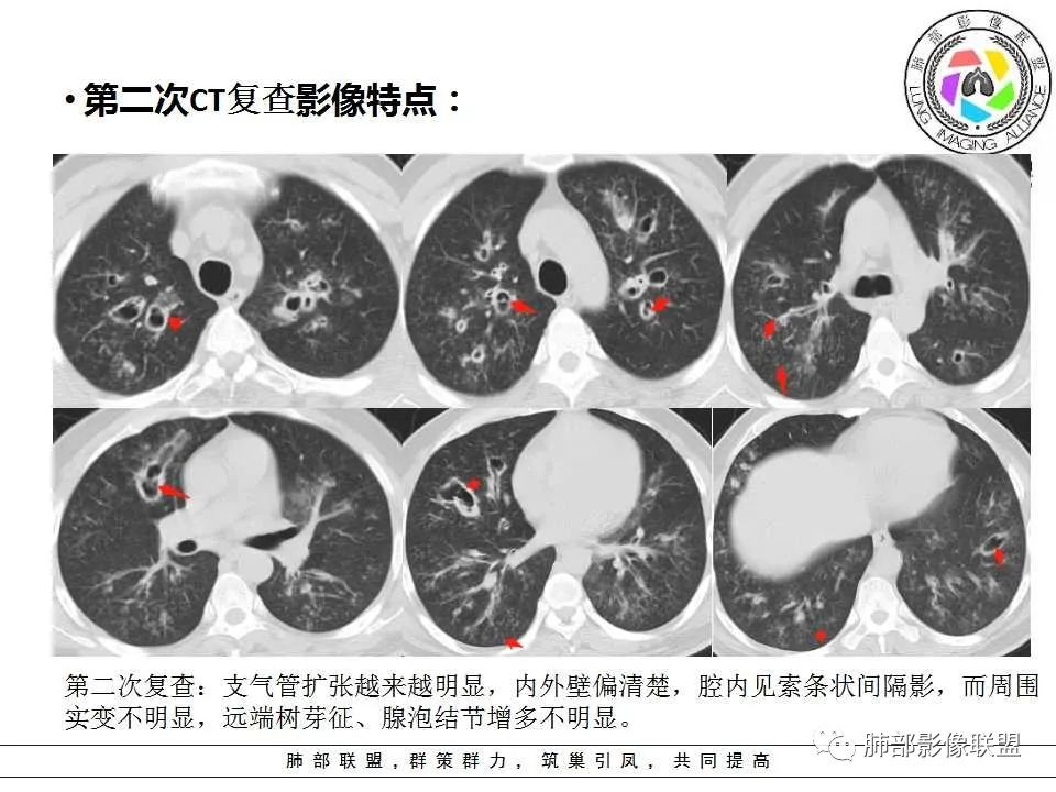 【PPT】侵袭性肺曲霉病影像分型及表现 【PPT】侵袭性肺曲霉病影像分型及表现