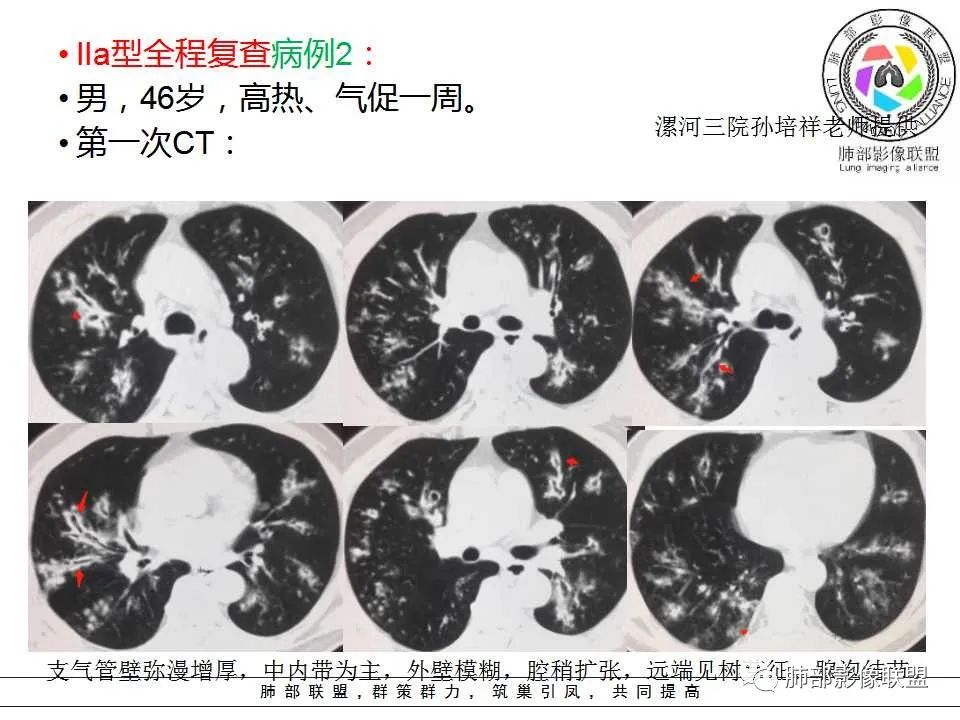 【PPT】侵袭性肺曲霉病影像分型及表现 【PPT】侵袭性肺曲霉病影像分型及表现