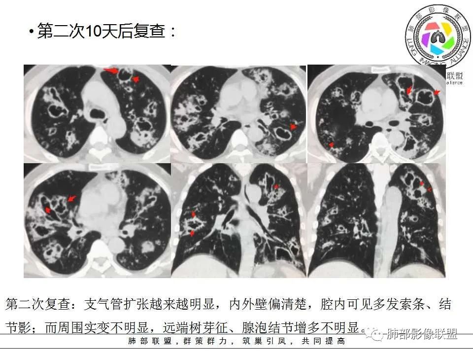 【PPT】侵袭性肺曲霉病影像分型及表现 【PPT】侵袭性肺曲霉病影像分型及表现