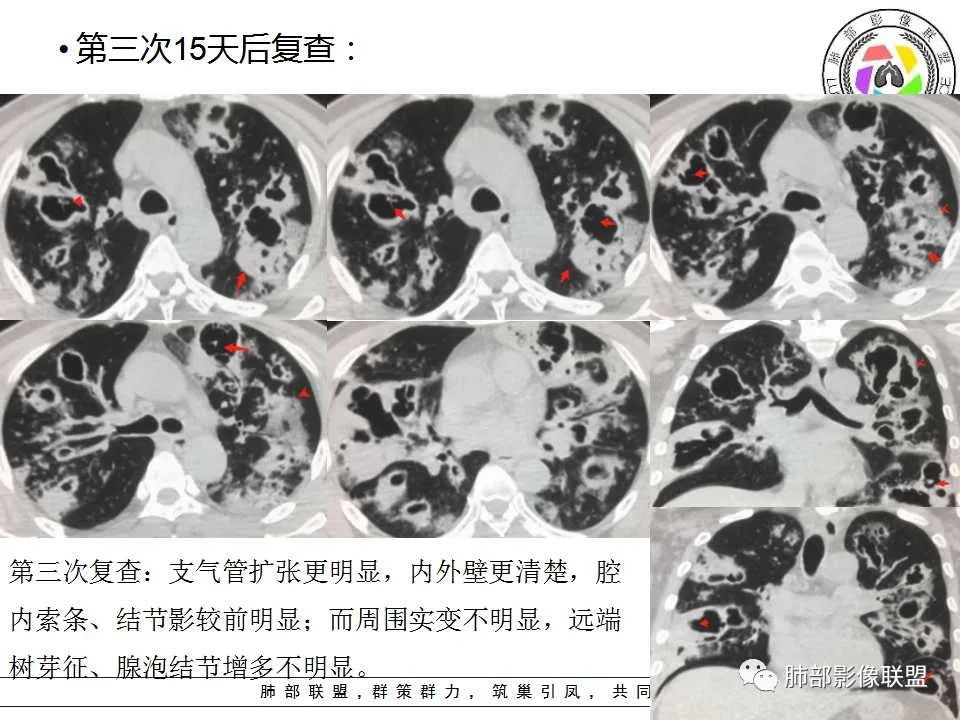 【PPT】侵袭性肺曲霉病影像分型及表现 【PPT】侵袭性肺曲霉病影像分型及表现