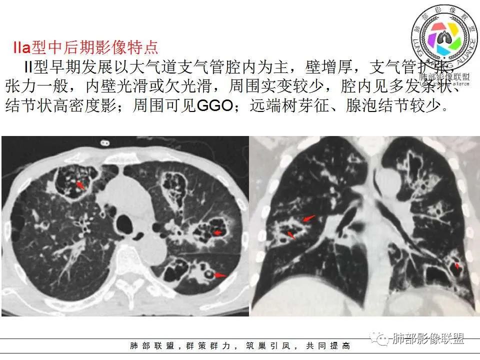 【PPT】侵袭性肺曲霉病影像分型及表现 【PPT】侵袭性肺曲霉病影像分型及表现