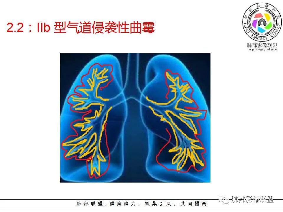 【PPT】侵袭性肺曲霉病影像分型及表现 【PPT】侵袭性肺曲霉病影像分型及表现