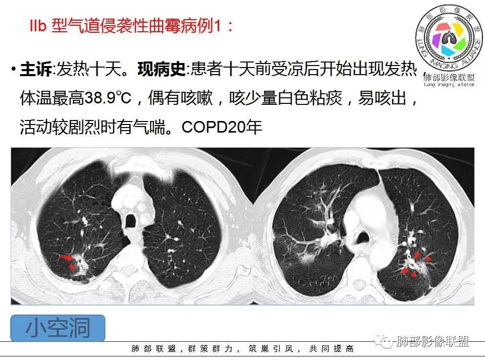 【PPT】侵袭性肺曲霉病影像分型及表现 【PPT】侵袭性肺曲霉病影像分型及表现