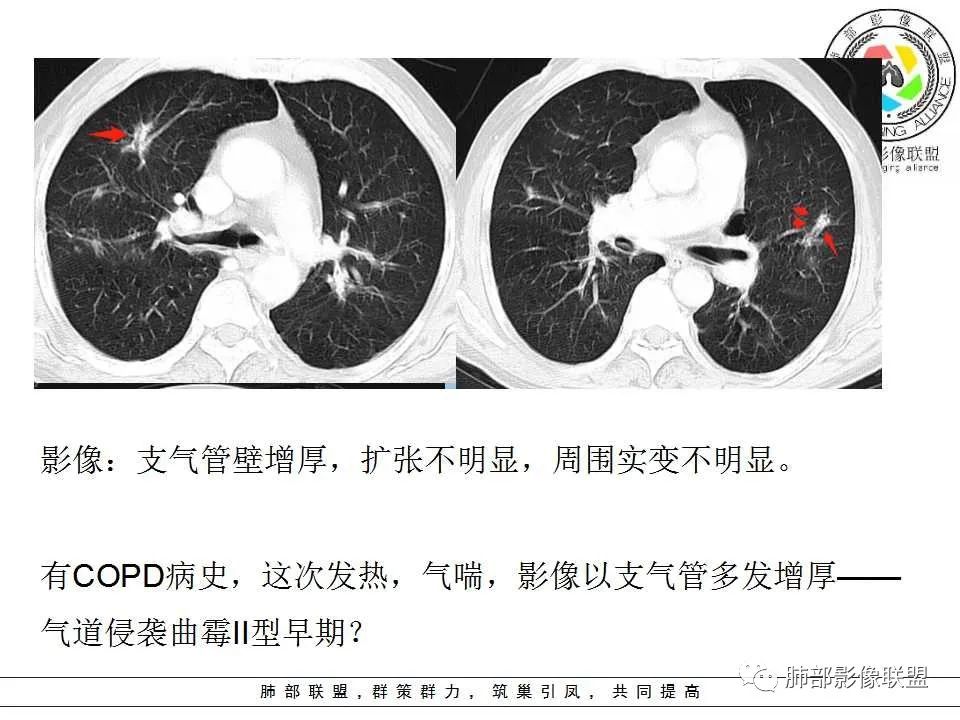 【PPT】侵袭性肺曲霉病影像分型及表现 【PPT】侵袭性肺曲霉病影像分型及表现