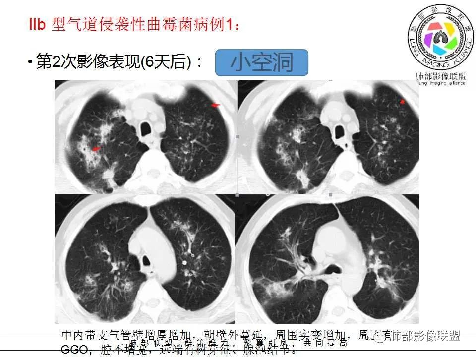 【PPT】侵袭性肺曲霉病影像分型及表现 【PPT】侵袭性肺曲霉病影像分型及表现