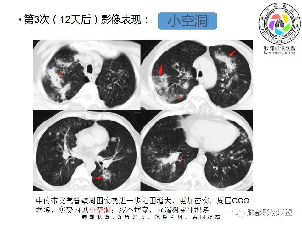 【PPT】侵袭性肺曲霉病影像分型及表现 【PPT】侵袭性肺曲霉病影像分型及表现