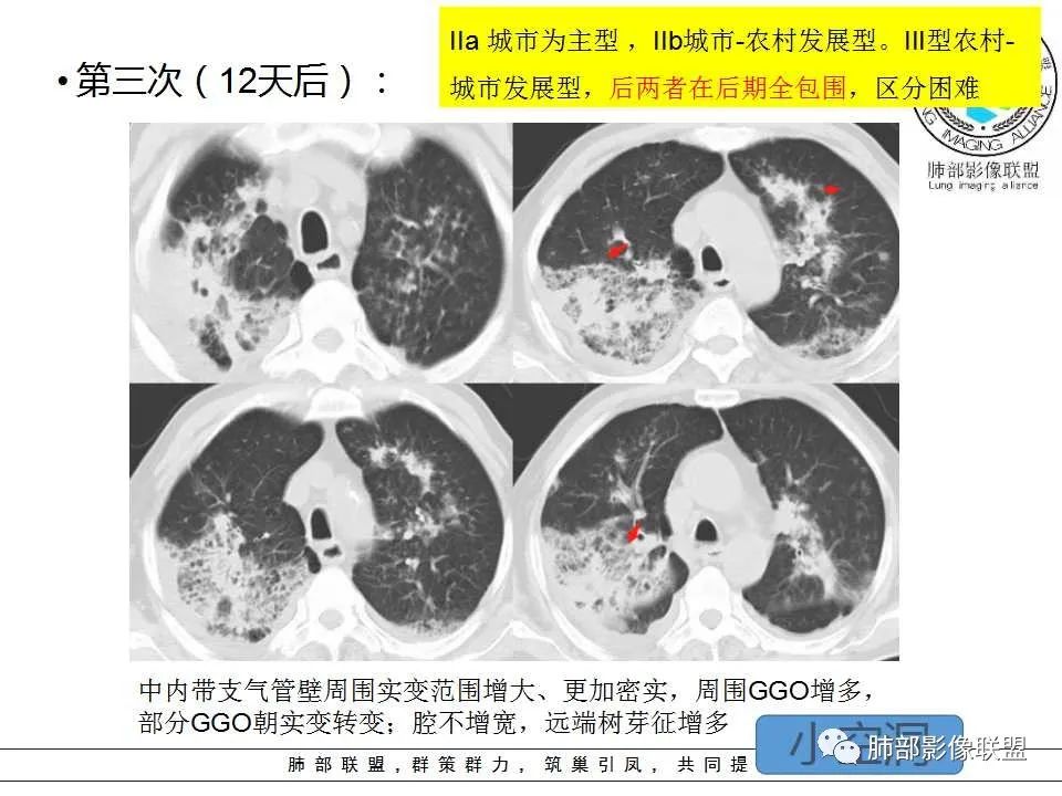 【PPT】侵袭性肺曲霉病影像分型及表现 【PPT】侵袭性肺曲霉病影像分型及表现