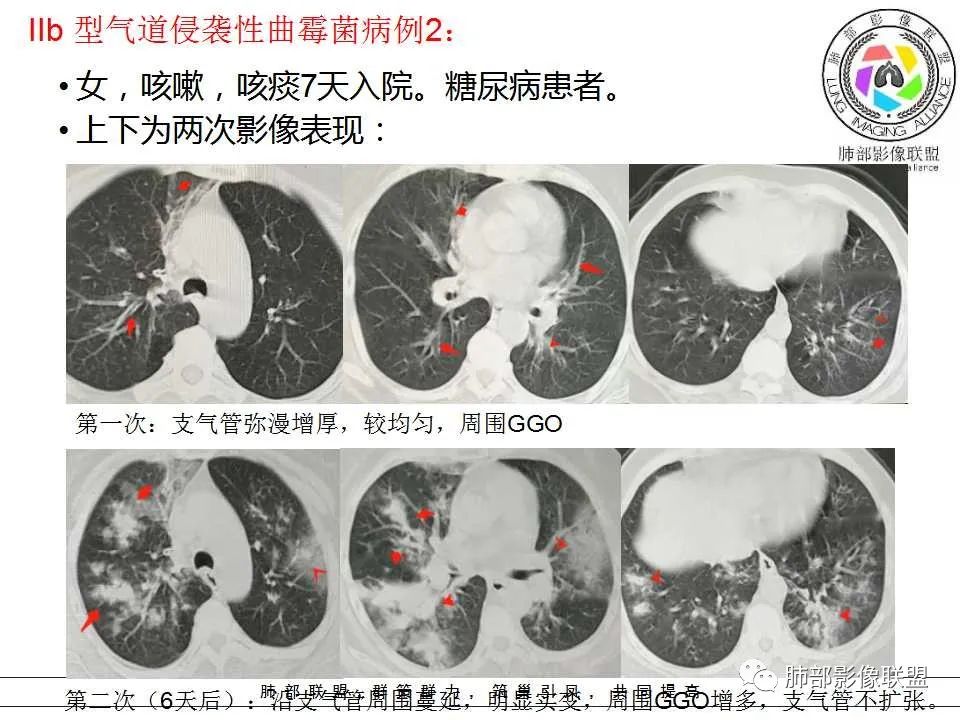【PPT】侵袭性肺曲霉病影像分型及表现 【PPT】侵袭性肺曲霉病影像分型及表现