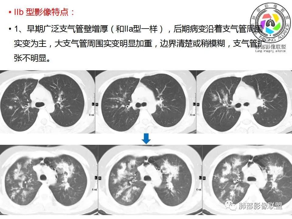 【PPT】侵袭性肺曲霉病影像分型及表现 【PPT】侵袭性肺曲霉病影像分型及表现