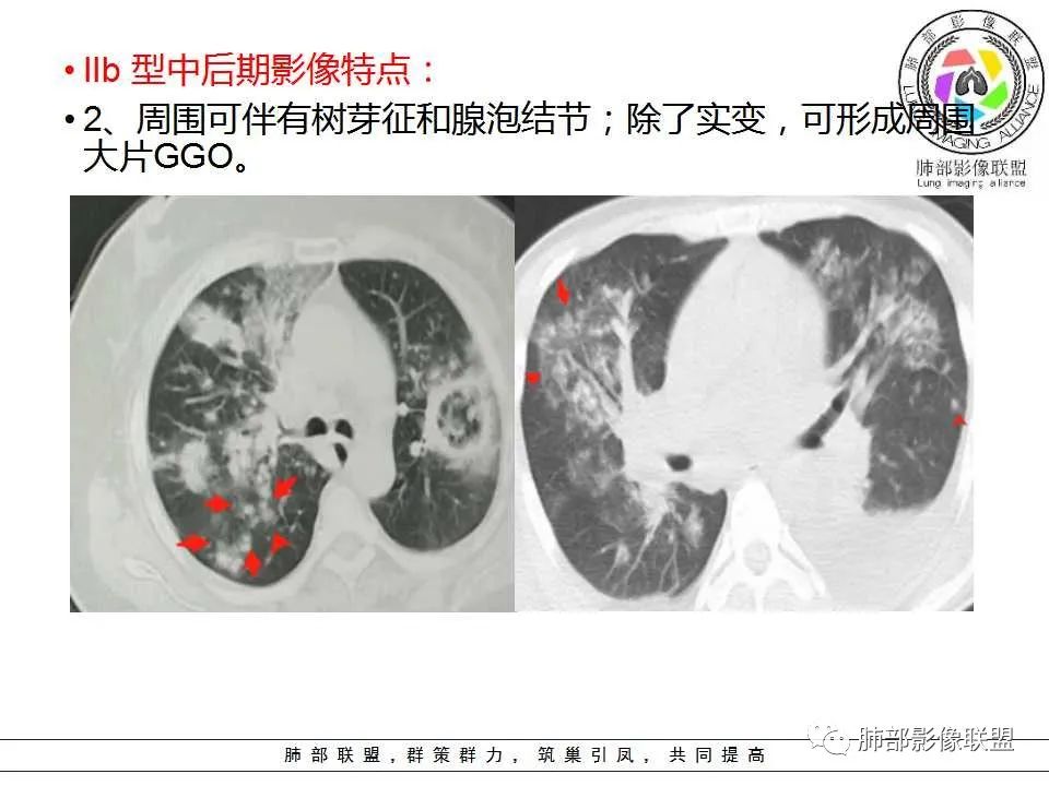 【PPT】侵袭性肺曲霉病影像分型及表现 【PPT】侵袭性肺曲霉病影像分型及表现