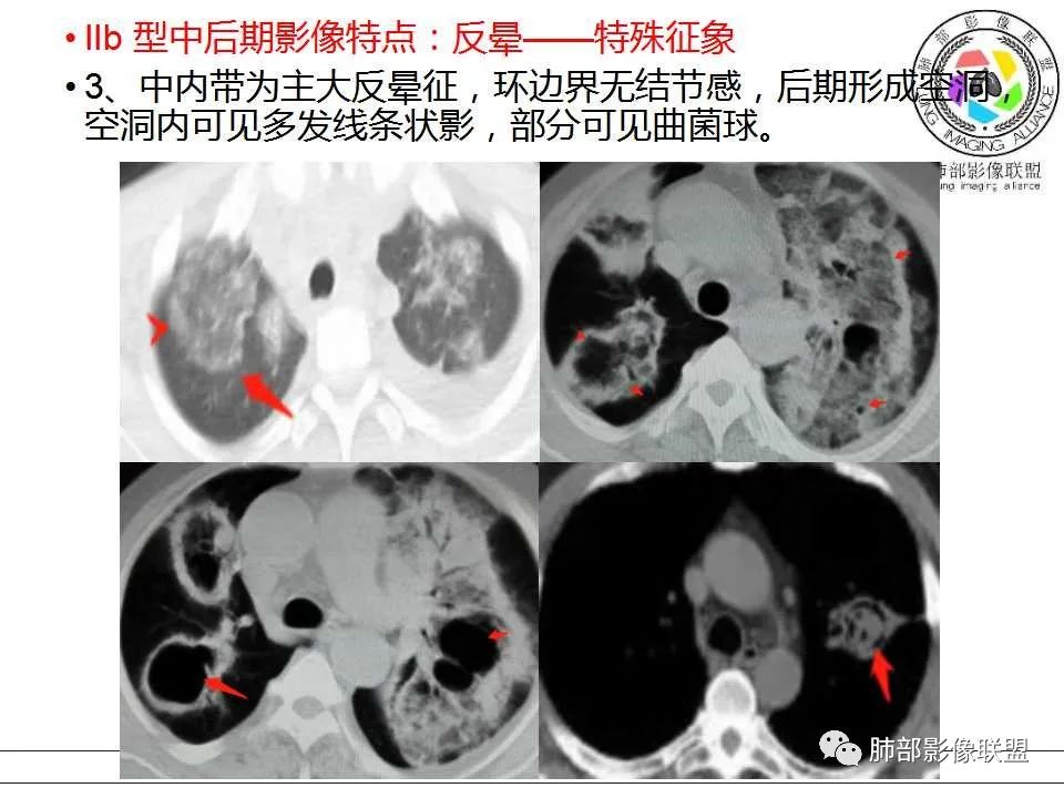 【PPT】侵袭性肺曲霉病影像分型及表现 【PPT】侵袭性肺曲霉病影像分型及表现