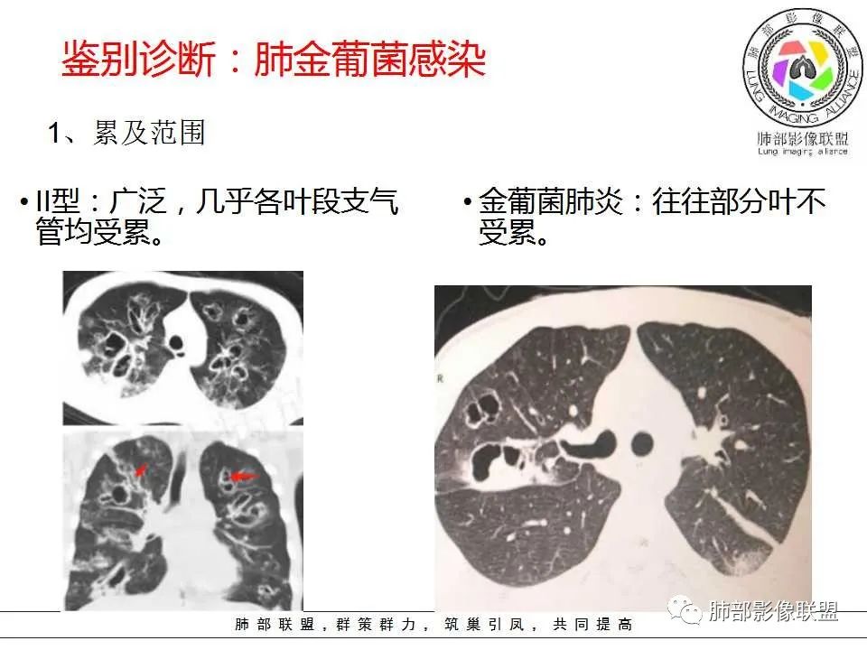 【PPT】侵袭性肺曲霉病影像分型及表现 【PPT】侵袭性肺曲霉病影像分型及表现