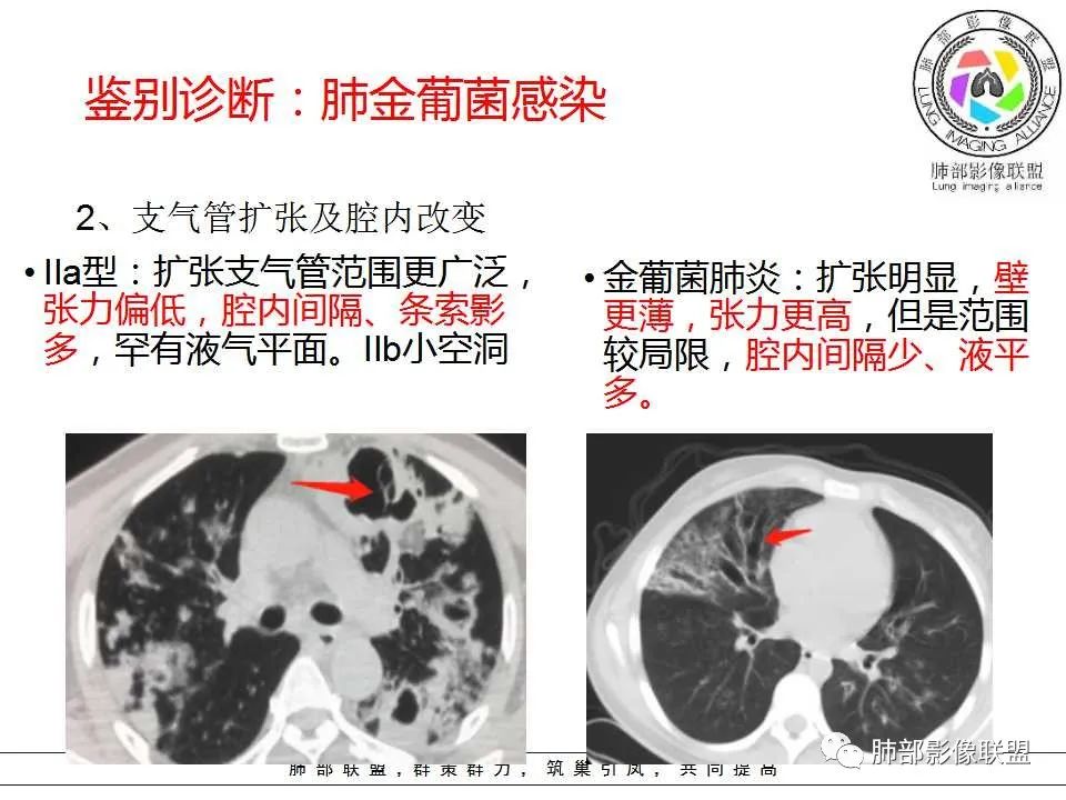 【PPT】侵袭性肺曲霉病影像分型及表现 【PPT】侵袭性肺曲霉病影像分型及表现